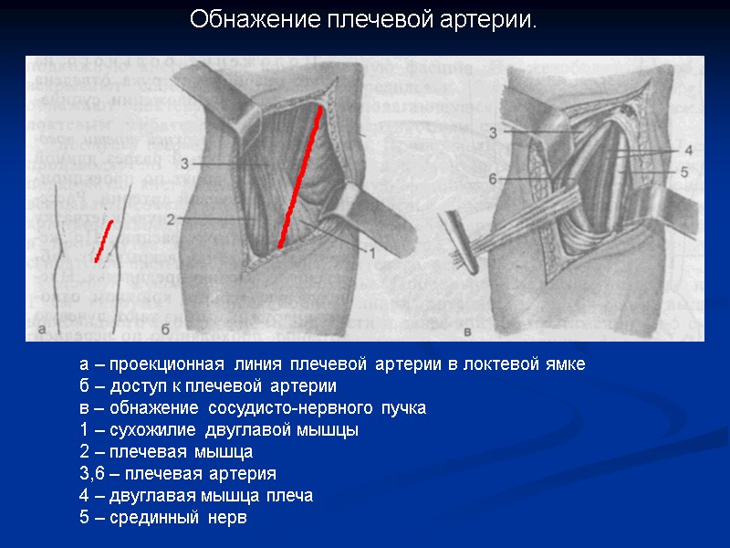 Обнажение плечевой артерии. а – проекционная линия плечевой артерии в локтевой ямке б –